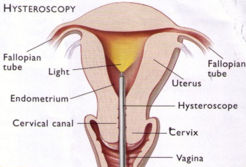 Hysteroscopy System