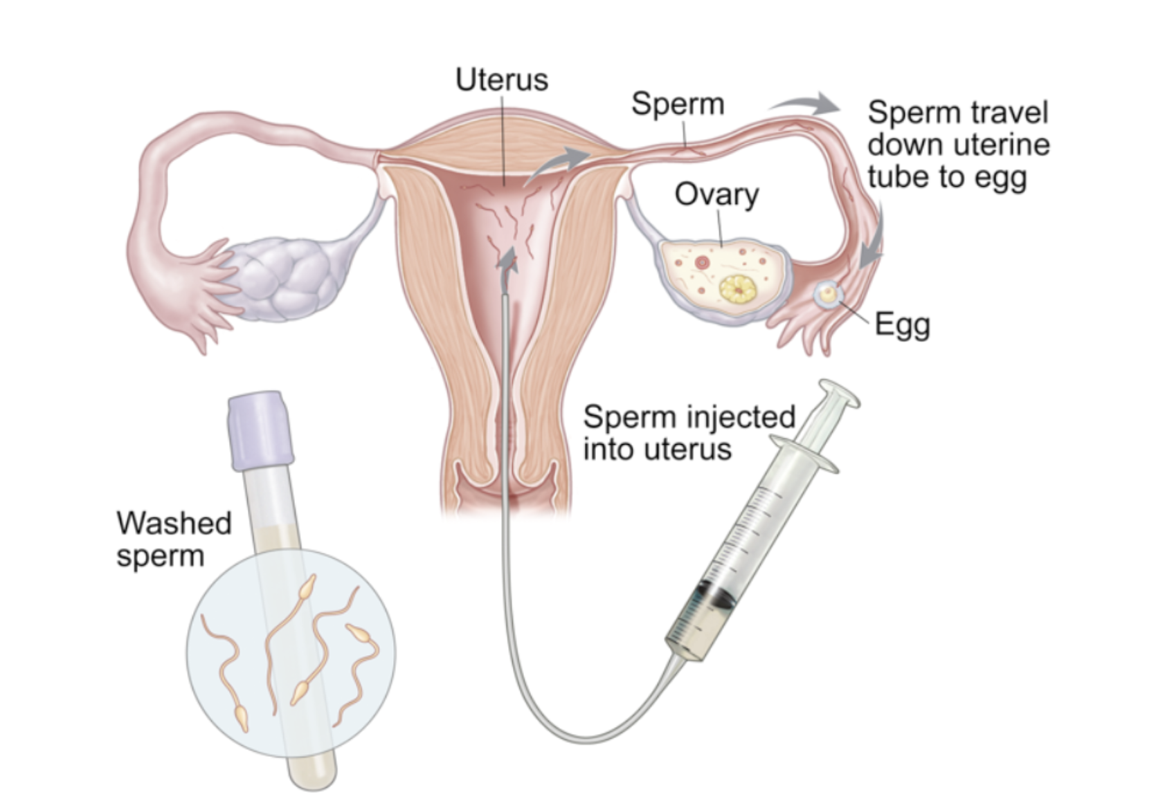 Intrauterine insemination